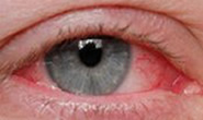 Blepharitis