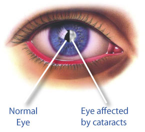 Cataract