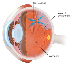 Retinal Detachment